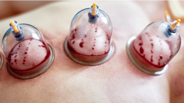Séance de hijama à Agadir